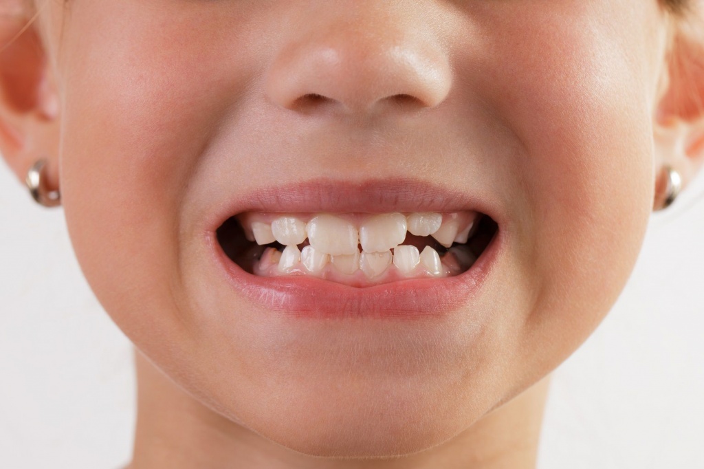 Лечение молочных зубов Томск Приветливая Иссечение капюшона зуба мудрости Томск Ракетная